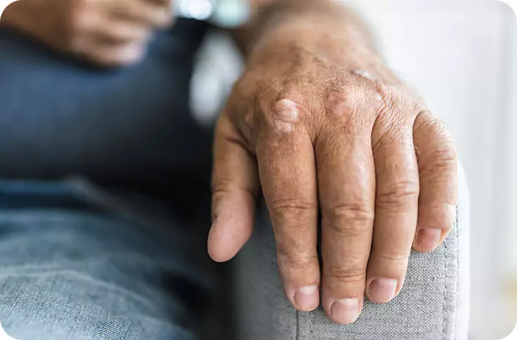 How to rid of eczema scars